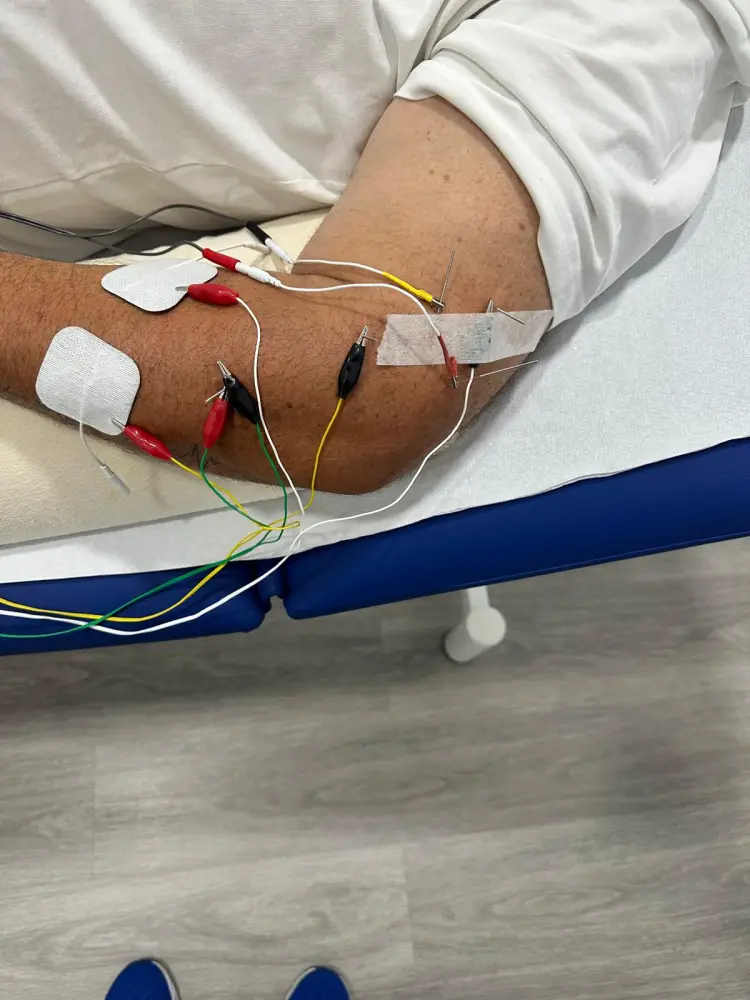 EPI y Neuromodulación Avanzada en DM Fisioterapia